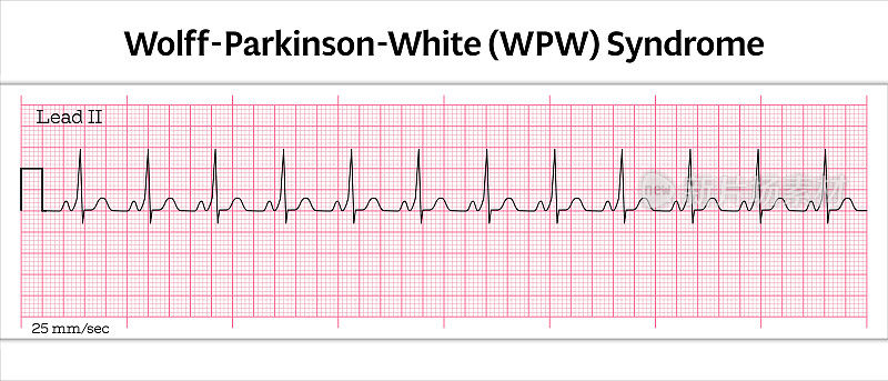 Wolff-Parkinson-White综合征(WPW) - 8秒心电图纸